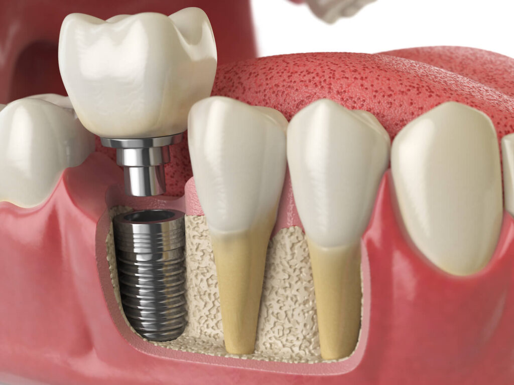 Dental Implants at Optima Hospital